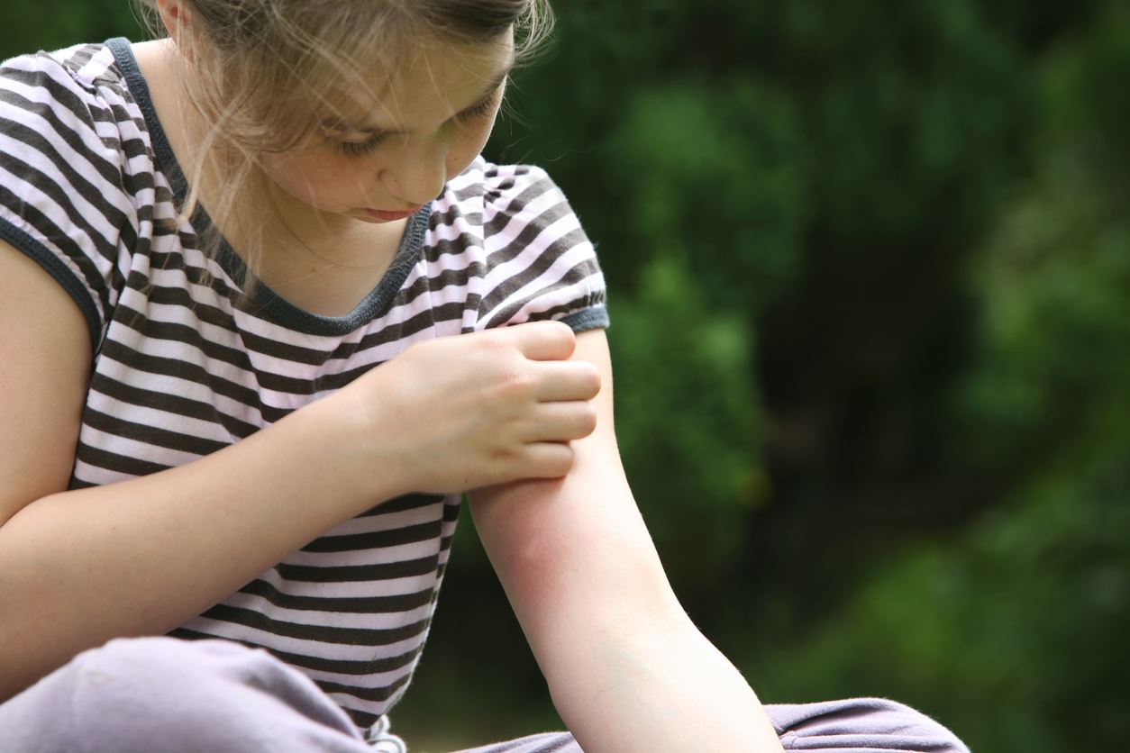 Allergies to Summer Insect Bites