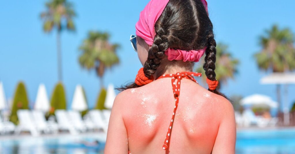 Sunburnt child